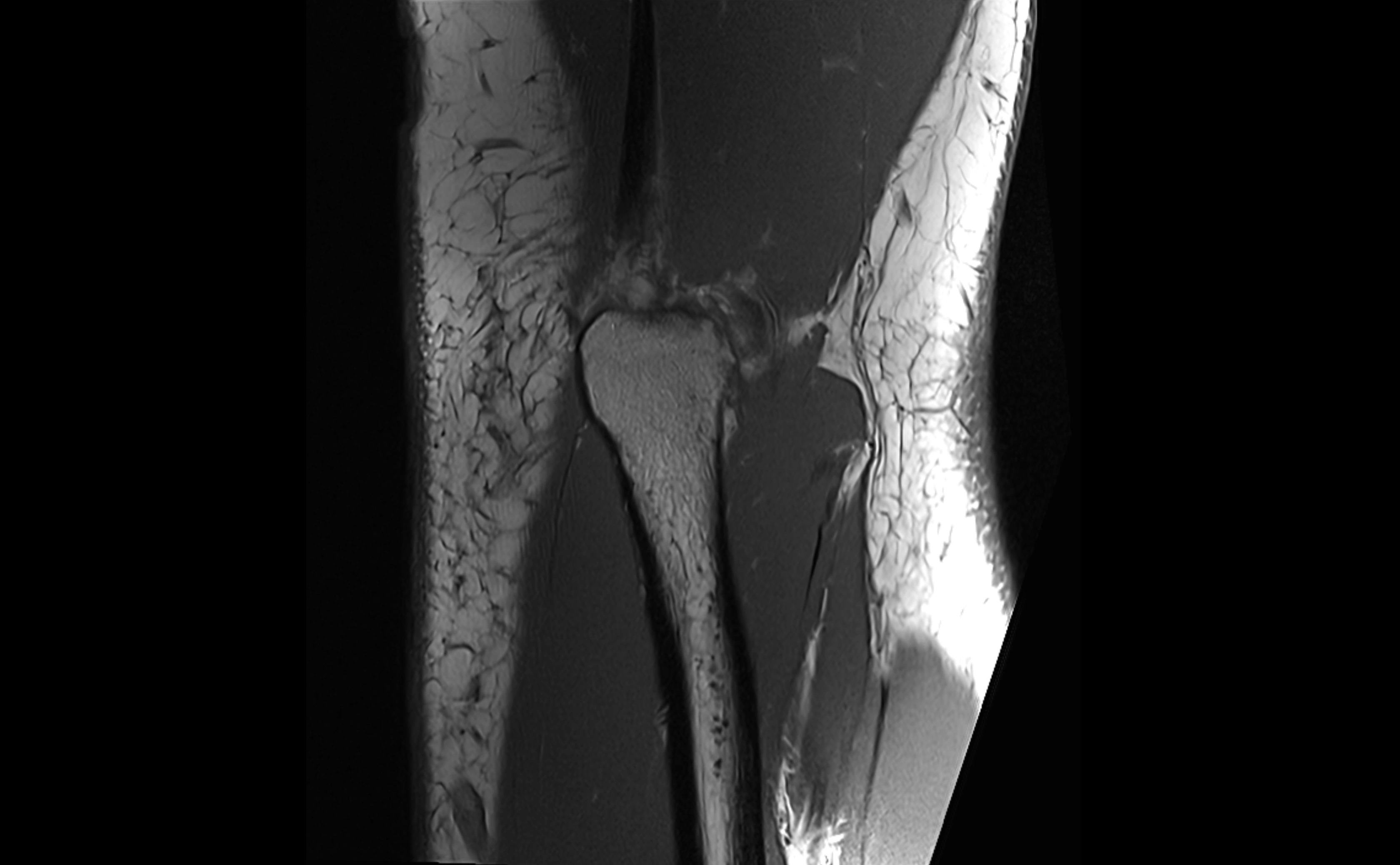 MRI elbow ligaments coronal cross sectional anatomy 3T  radiology  image-img-07001-00027.webp